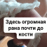 «Зашивали в нескольких местах под наркозом»: саратовчанка рассказала, как ее сын стал жертвой нападения бродячего пса - ИА Версия-Саратов