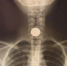 Балаковские врачи достали из пищевода ребенка пятирублевую монету - Saratov24.TV